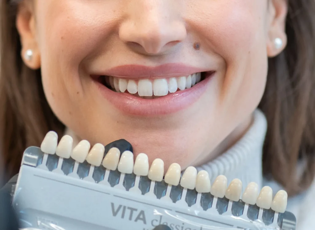cosa sono le faccette dentali